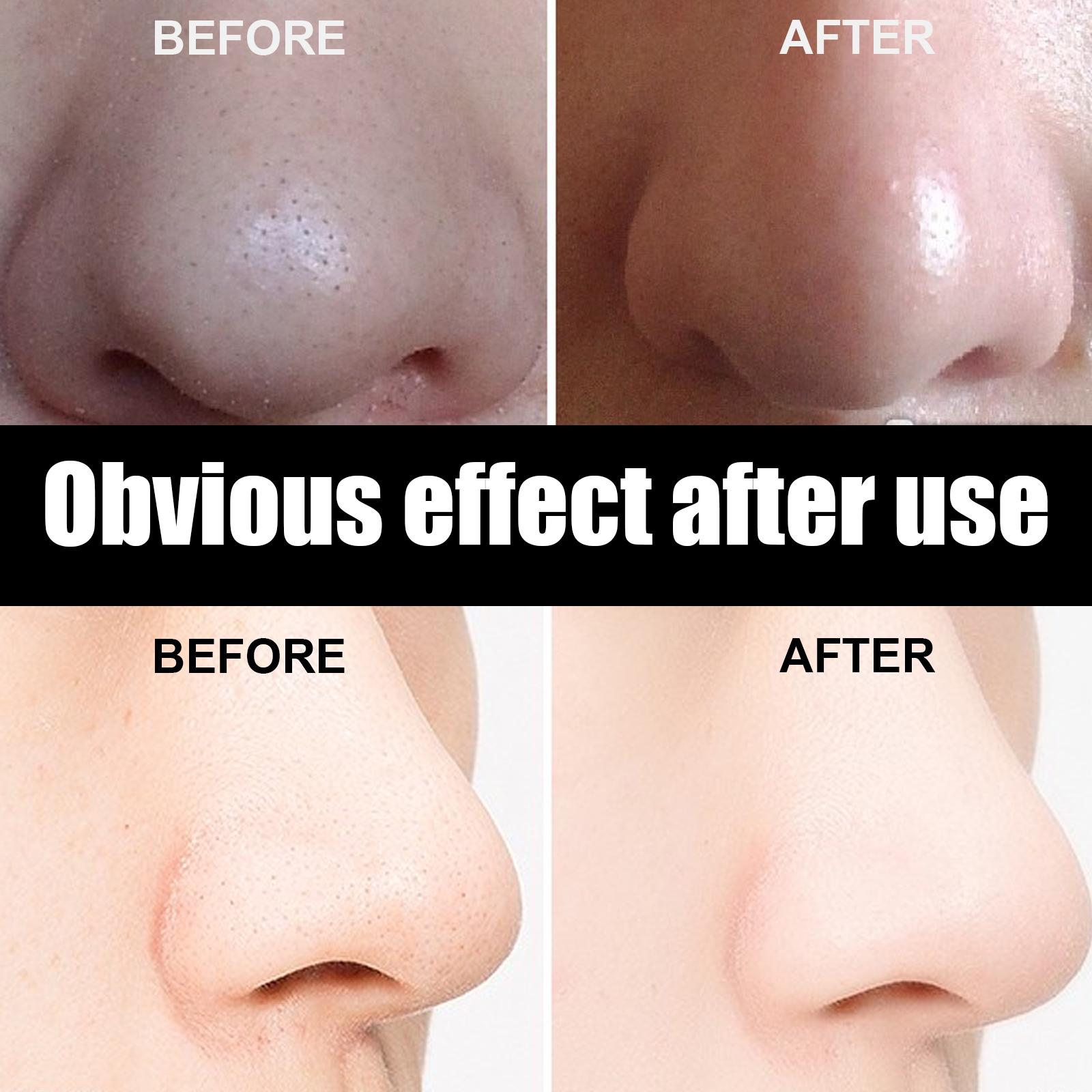 Blackhead Nose Pore Cleansing Strips